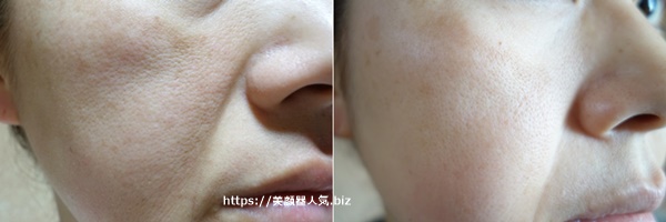 rfボーテフォトプラスexを使った肌の変化