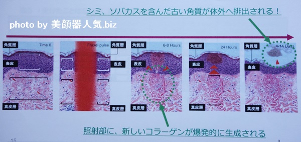 フラクショナルレーザー