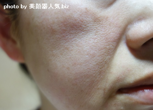 レーザー美顔器おすすめ