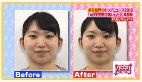 メディリフトの使う前と使った後の画像