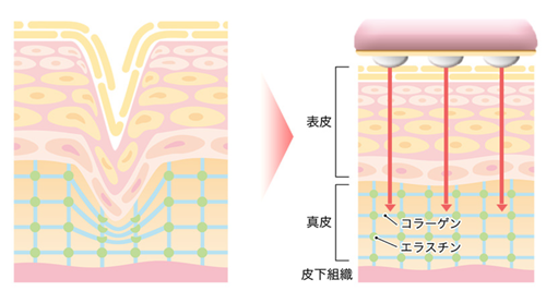 RF美顔器ランキング