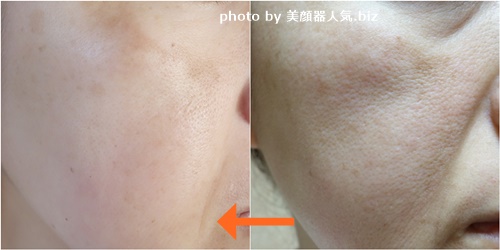 トリアスキンエイジングケアレーザー6ヶ月口コミ